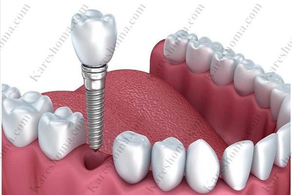 متخصص پروتزهای دندانی و ایمپلنت اهواز